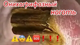 Онихогрифозный ноготь 😱😨⚠️🆘❗️❗️❗️