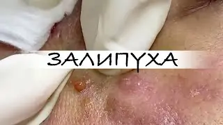 ПРЫЩИ 😍 ПРЫЩИ ВЫДАВЛИВАНИЕ 😍 ПОДБОРКА ВЫДАВЛИВАНИЕ ПРЫЩЕЙ 