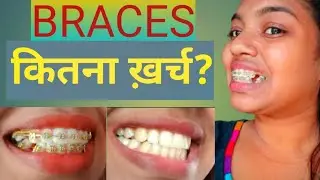 BRACES COST/ ब्रेसेज़ लगाने में कितना खर्चा? #bracescost #ब्रेसेज़लगानेमेंकितनाखर्चा? #braces