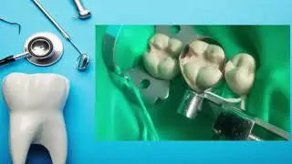 Opturación clase II 3-6 3-7