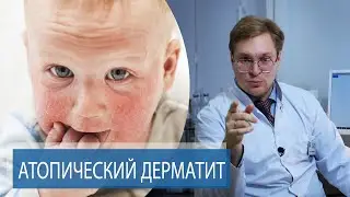 АТОПИЧЕСКИЙ ДЕРМАТИТ | Как лечить ДИАТЕЗ