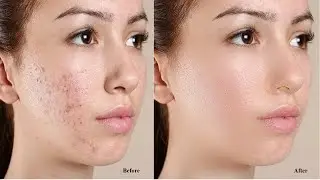 How to Clean face acne in photoshop || Photoshop clean face || Clear Pic in Photoshop