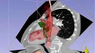 Mid-Esophageal Long-Axis Imaging Plane in TEE - Standard View