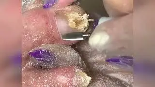 Грибок🍄 • Микоз ногтей🆘⚠️😱