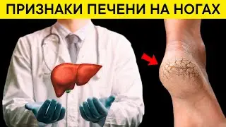 Трещины на пятках, кожный зуд? Проверьте свою ПЕЧЕНЬ! Признаки БОЛЕЗНЕЙ ПЕЧЕНИ на ногах