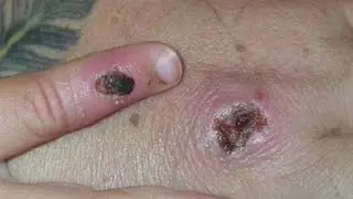 LA County confirms first suspected case of monkeypox in 2022