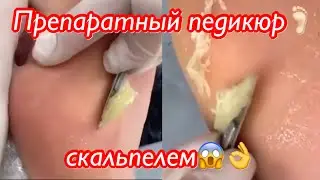 Препаратный педикюр🦶🏻скальпелем😱💯👌