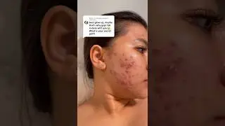 Products that I used that saved my skin 🫶🏻