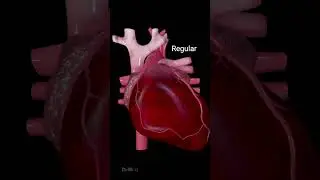 Heart Arrhythmias: Different Types and Symptoms