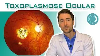 Toxoplasmose ocular - tratamento