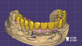 Изготовление балки с уступом ExoCad + B4D ( blender for dental)