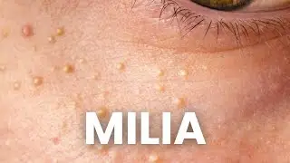 3 Proven Strategies to Remove Milia that WORK!