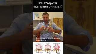 Чем протрузия отличается от грыжи?