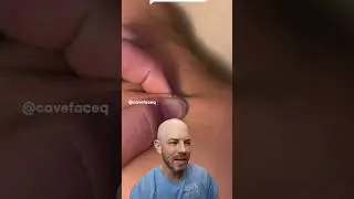 Little pimple pop! 👶 #doctorreacts #pimplelife #satisfying