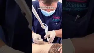 Как удаляют множественные папилломы🔥 Больше о здоровье на канале #врач #хирург #врачкрым #проктолог