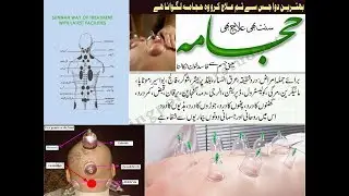 Hajama at home | Gunch pan ka elaj | hajama clinic | hajama in karachi | hajama at your doorstep