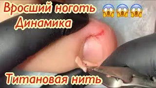 Вросший ноготь😱😱😱 • Титановая нить • Динамика