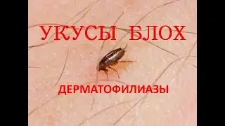 Блохи. Укусы блох (Дерматофилиазы)