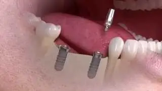 Straumann - Implant-borne multi-tooth treatment