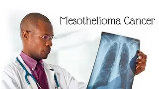 Pleural mesothelioma