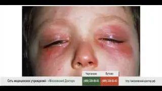 Аллергия на холод