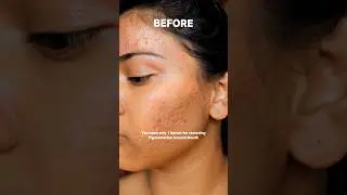 One serum for pigmentation around mouth | Remove pigmentation around mouth 