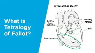 What is Tetralogy of Fallot?