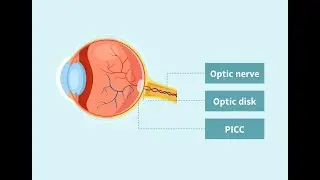 Shedding Light on PICC: A Condition Associated with Visual Defects in People with Short-sightedness