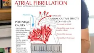 Identifying Afib on ECG