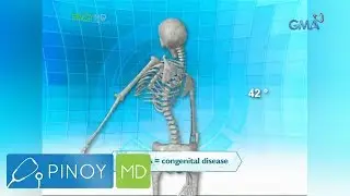 Pinoy MD: Nagagamot ba ang scoliosis?