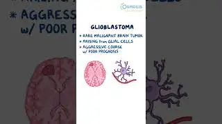 Glioblastoma