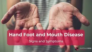 Hand Foot and Mouth Disease Symptoms