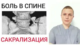 Боль в Спине l Сакрализация Люмбализация l Sacralization ( Back Pain )