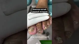 Обработка сложных ногтей🦶🏼Как вам? Автор: amanda.podologia12 
