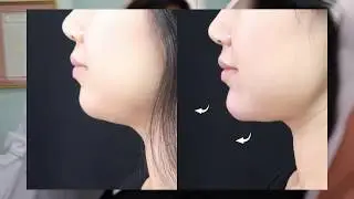 Voluma Non-Surgical Chin Augmentation | Dr. Usha Rajagopal