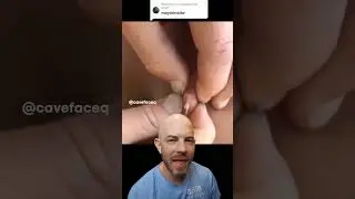 This pop looks like a mayonnaise explosion! 🤢 #satisfying #dermreacts #doctor #doctorreacts
