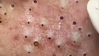 Blackheads & Whiteheads Satisfying Removal @0178