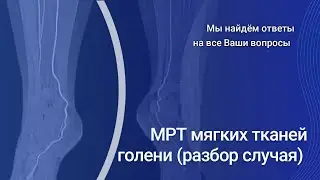 МРТ мягких тканей голени