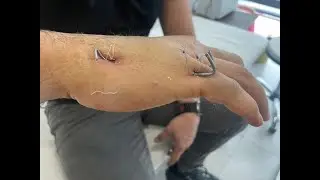 Metacarpal (Boksör) Kırığı | Evde Fizik Tedavi Uygulaması