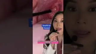 Awesome Tool for removing Juicy Tonsil Stones 