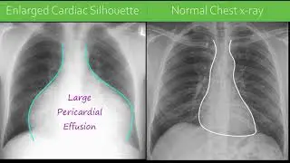 Chest x-ray  - Pericardial Effusion