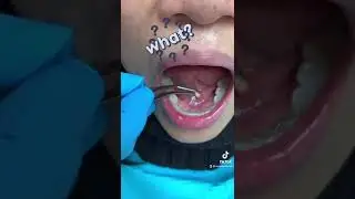 Salivary Gland Stone 