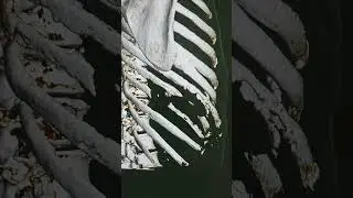 Метастазы рака лёгкого в ребрах.