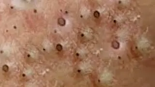 Blackheads & Whiteheads Satisfying Removal @0184