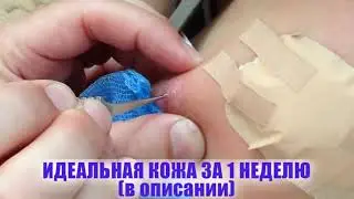 #12 ОГРОМНЫЕ ЧЕРВИ ПОД КОЖЕЙ ДЕВУШКИ, УДАЛЕНИЕ