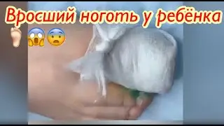 Вросший ноготь у ребёнка😱🦶🏻😮