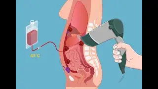 Dehydration, Heat and Chemotherapy Could Offer a Knockout Punch for Peritoneal Cancer