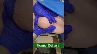 Normal Delivery