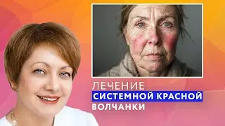 ЛЕЧЕНИЕ СИСТЕМНОЙ КРАСНОЙ ВОЛЧАНКИ // #zdravclinic