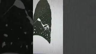 Кавернозный туберкулёз на КТ.